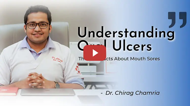 Understanding Oral Ulcers